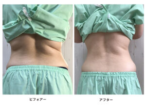 健康の森整体院　30歳女性痩身ビフォーアフター後ろ姿