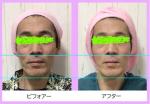 男性フェイシャルビフォアーアフター写真
